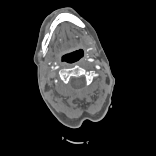 File:C2 fracture with vertebral artery dissection (Radiopaedia 37378-39200 A 161).png