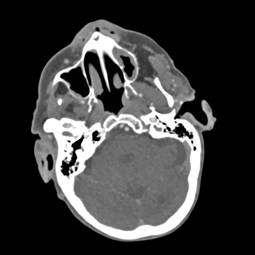 C2 fracture with vertebral artery dissection (Radiopaedia 37378-39200 A 207).png