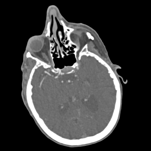 C2 fracture with vertebral artery dissection (Radiopaedia 37378-39200 A 236).png