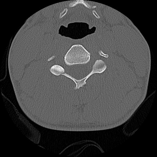 File:C5 facet fracture (Radiopaedia 58374-65499 Axial bone window 47).jpg