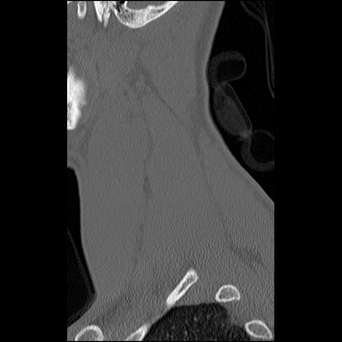 C5 facet fracture (Radiopaedia 58374-65499 Sagittal bone window 60).jpg