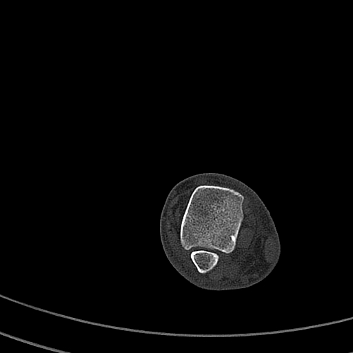Calcaneal fracture - Sanders type 4 (Radiopaedia 90179-107370 Axial bone window 17).jpg