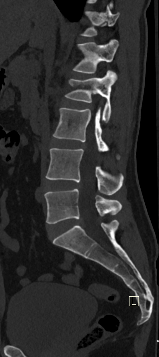 Calcaneal fractures with associated L2 burst fracture (Radiopaedia 71671-82493 Sagittal bone window 44).jpg