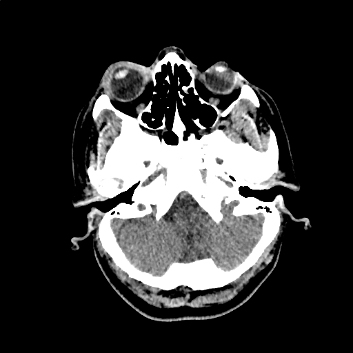 Calcified cerebral hydatid cyst (Radiopaedia 65603-74717 Axial non-contrast 5).jpg