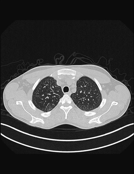 Calcifying pulmonary metastases (Radiopaedia 33359-34396 Axial lung window 14).jpg
