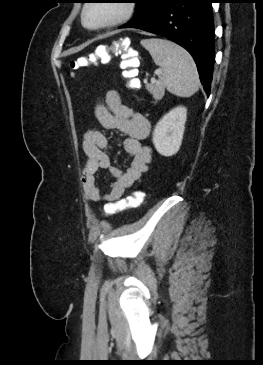 Carcinoid tumor - terminal ileum (Radiopaedia 60931-68739 C 15).jpg