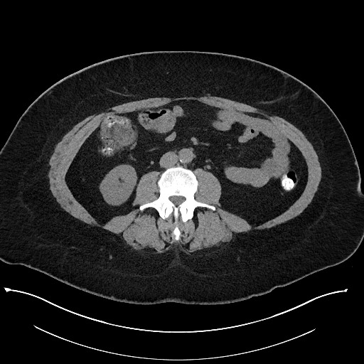 File:Carcinoid tumor - terminal ileum (Radiopaedia 60931-68740 Axial non-contrast 60).jpg