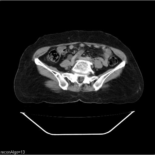 File:Carcinoma cervix- recurrence (Radiopaedia 34702-36137 B 36).jpg