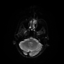 Carcinoma ex-pleomorphic adenoma of parotid (Radiopaedia 28383-28627 Ax DWI B-500 GE 25).jpg
