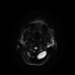 Carcinoma ex-pleomorphic adenoma of parotid (Radiopaedia 28383-28627 Ax DWI B-500 GE 56).jpg