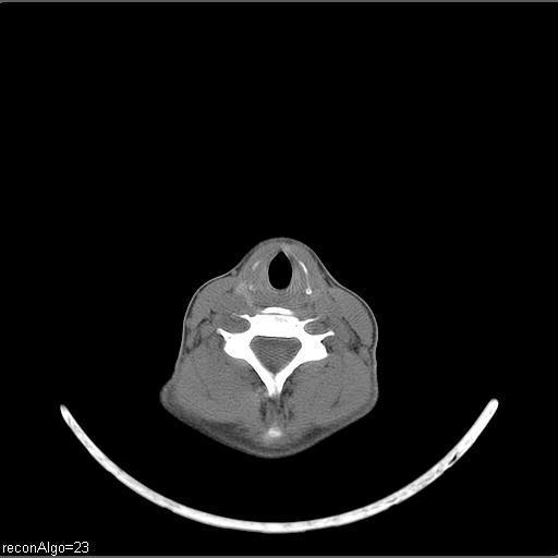 Carcinoma of the maxillary antrum (Radiopaedia 53805-59888 Axial non-contrast 23).jpg