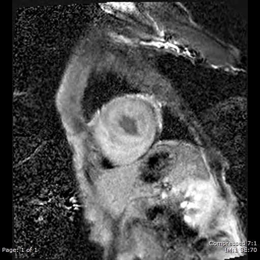 File:Cardiac amyloidosis (Radiopaedia 62017-70102 K 1).jpg