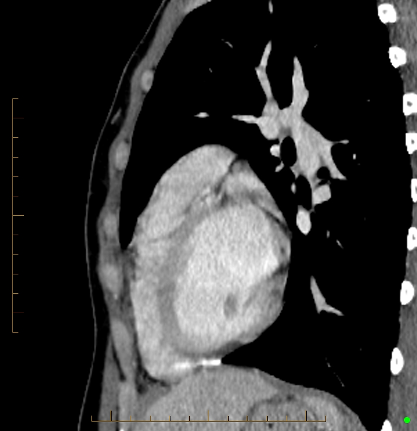 Cardiac paraganglioma (Radiopaedia 76345-88005 C 29).jpg