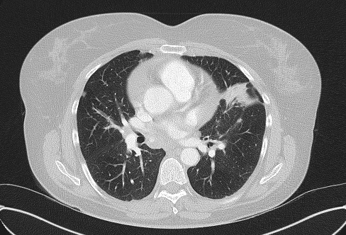 Cardiac sarcoidosis (Radiopaedia 74548-85534 Axial lung window 42).jpg