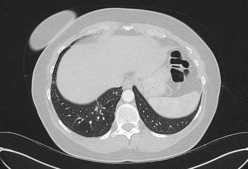 File:Cardiac sarcoidosis (Radiopaedia 74548-85534 Axial lung window 76).jpg