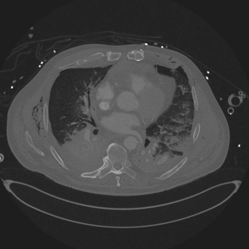 Cardiac trauma (Radiopaedia 32874-33858 Sagittal bone window 1).jpg