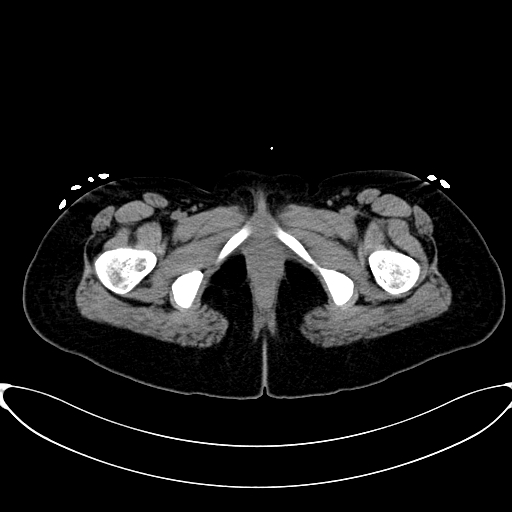 Caroli disease with medullary sponge kidney (Radiopaedia 82622-96804 Axial non-contrast 80).jpg