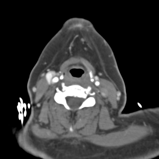 Carotico ophthalmic aneurysm (Radiopaedia 42916-46148 A 72).png