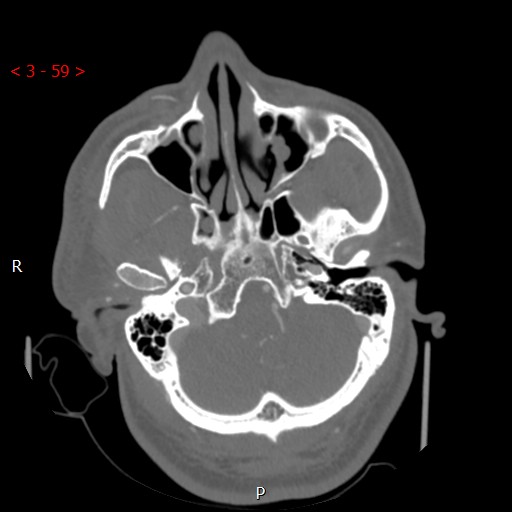 Caroticocavernous fistula (Radiopaedia 42346-45457 A 17).jpg