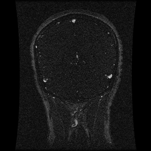 Carotid arterial dissection with acute cerebral infarction (Radiopaedia 26636-26784 MRV 64).jpg