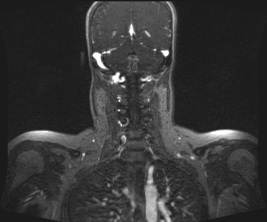 Carotid body tumor (Radiopaedia 12777-12912 MRA 52).jpg