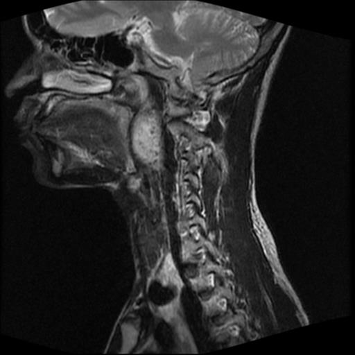 File:Carotid body tumor (Radiopaedia 30208-30823 Sagittal T2 12).jpg