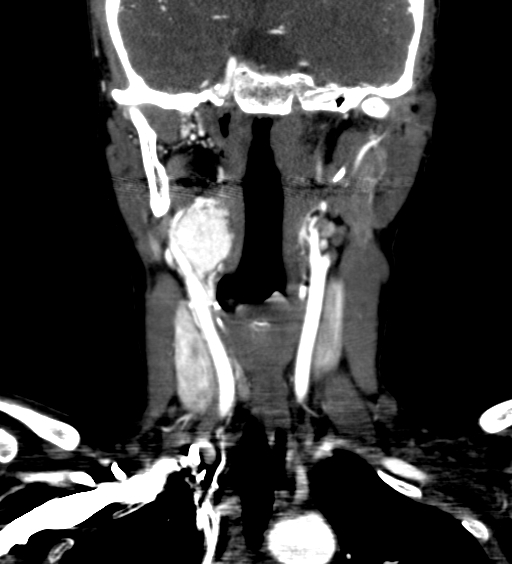 File:Carotid body tumor (Radiopaedia 39845-42300 C 28).jpg