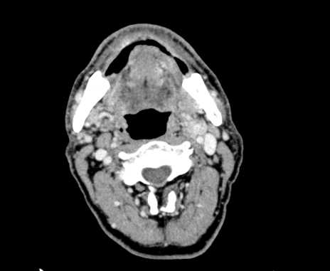 Carotid body tumor (Radiopaedia 61750-69757 Axial Post contrast 37).jpg