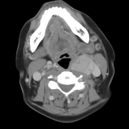Carotid body tumor (paraganglioma) (Radiopaedia 38586-40729 A 18).jpg