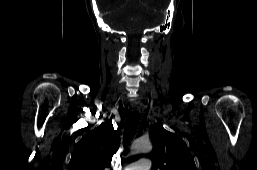 File:Carotid bulb pseudoaneurysm (Radiopaedia 57670-64616 D 50).jpg