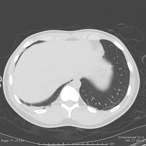 Catamenial pneumothorax (Radiopaedia 54382-60600 Axial non-contrast 77).jpg