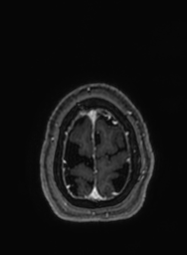 File:Cavernous hemangioma of the cerebellar falx (Radiopaedia 73025-83724 Axial T1 C+ 36).jpg