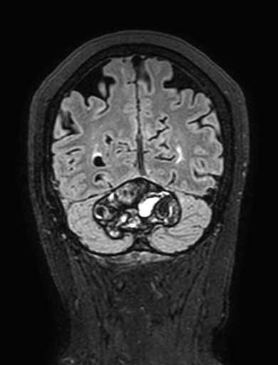 Cavernous hemangioma of the cerebellar falx (Radiopaedia 73025-83724 Coronal FLAIR 284).jpg