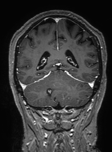 Cavernous hemangioma of the cerebellar falx (Radiopaedia 73025-83724 Coronal T1 C+ 266).jpg