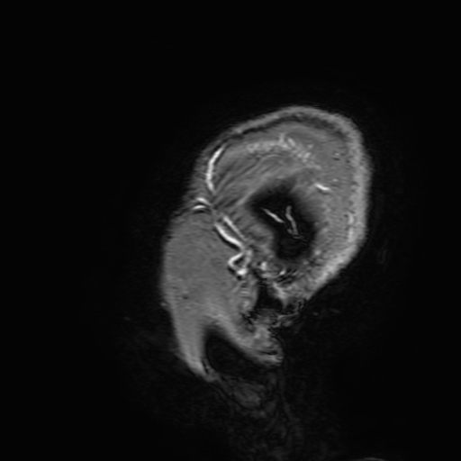 Cavernous hemangioma of the cerebellar falx (Radiopaedia 73025-83724 Sagittal T1 C+ 207).jpg