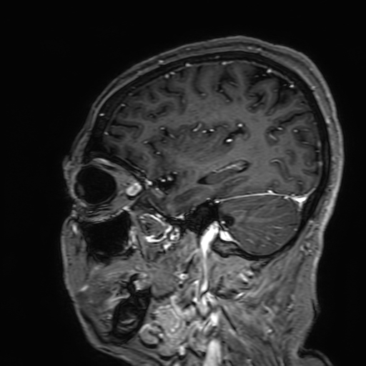 Cavernous hemangioma of the cerebellar falx (Radiopaedia 73025-83724 Sagittal T1 C+ 56).jpg