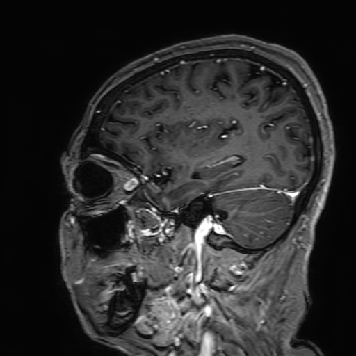 Cavernous hemangioma of the cerebellar falx (Radiopaedia 73025-83724 Sagittal T1 C+ 57).jpg