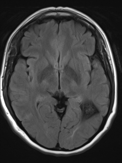 File:Cavernous malformation (cavernous angioma or cavernoma) (Radiopaedia 36675-38237 Axial T2 FLAIR 10).png