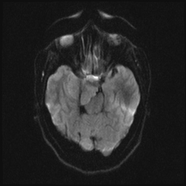 Cavernous sinus meningioma (Radiopaedia 63682-72367 DWI 29).jpg