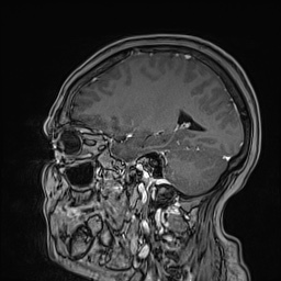Cavernous sinus meningioma (Radiopaedia 63682-72367 Sagittal T1 C+ 115).jpg