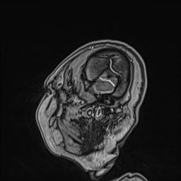 Cavernous sinus meningioma (Radiopaedia 63682-72367 Sagittal T1 C+ 29).jpg