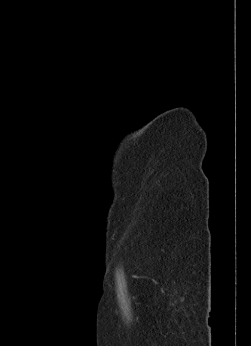 Cecal adenocarcinoma - surgical scar recurrence (Radiopaedia 79988-93264 D 68).jpg