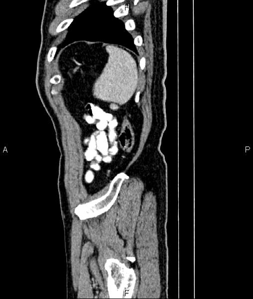 File:Cecal cancer with appendiceal mucocele (Radiopaedia 91080-108651 E 88).jpg