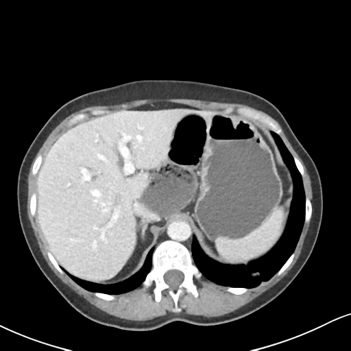 Cecal internal hernia through the foramen of Winslow (Radiopaedia 44820-48651 B 16).png