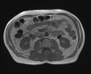 Cecal mass causing appendicitis (Radiopaedia 59207-66532 Axial T1 in-phase 67).jpg