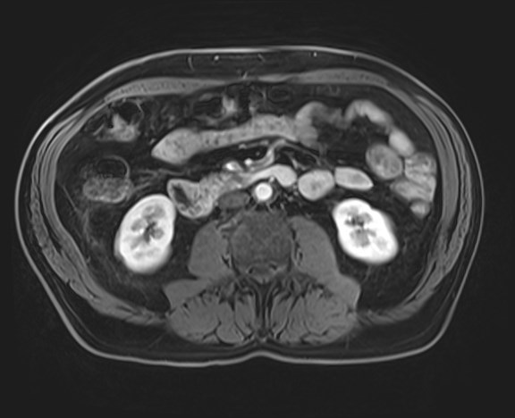 Cecal mass causing appendicitis (Radiopaedia 59207-66532 H 71).jpg