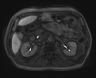 Cecal mass causing appendicitis (Radiopaedia 59207-66532 K 54).jpg