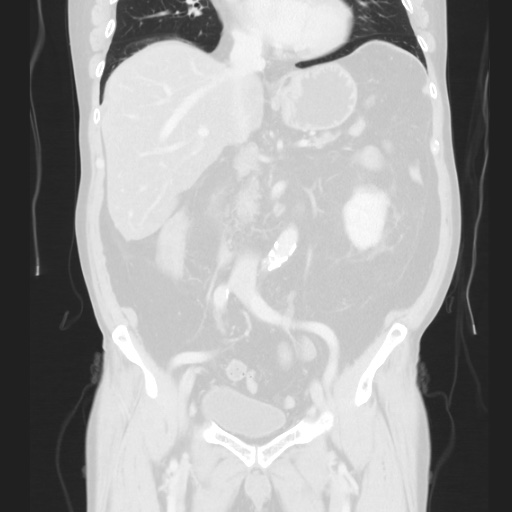 Cecal volvulus (Radiopaedia 75378-86620 Coronal lung window 73).jpg