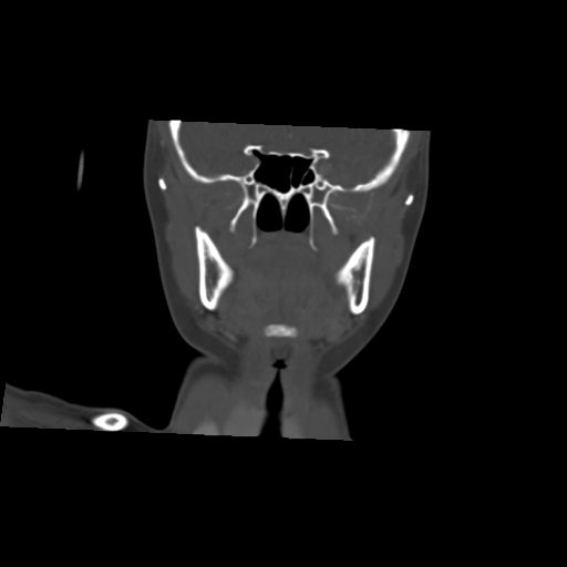Cemento-ossifying fibroma (Radiopaedia 46243-50643 Axial bone window 1).png