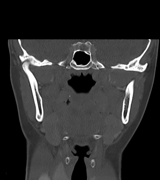 Cemento-ossifying fibroma (Radiopaedia 46243-50643 Coronal bone window 34).png